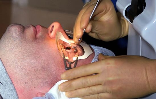 Escleroplastia para miopía para estabilizar a visión